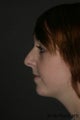 Chin Augmentation & Rhinoplasty
