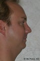 Chin Augmentation 