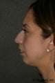 Chin Augmentation 