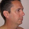 Chin Implant and Neck Liposuction