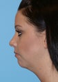 Chin Implant