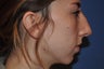 Chin Augmentation with Rhinoplasty