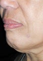Chin Augmentation