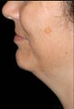 Chin Liposuction and Augmentation