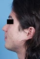 Chin Implant