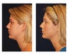 Chin Lipo