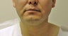 Chin Liposuction 