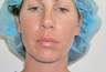 Chin Liposuction 
