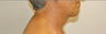 Chin Liposuction 