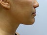 Liposuction to chin/neck area