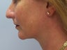 Liposuction of chin/neck area