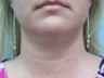 Liposuction of the neck/chin