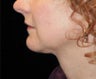 Chin Liposuction