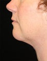 Chin Liposuctioni