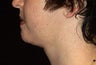 Chin Liposuction