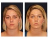 Chin Lipo