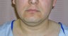 Chin Liposuction 