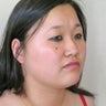 Chin Liposuction 
