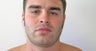 Chin Liposuction 