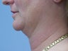 Liposuction of chin/neck area