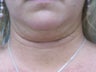 Liposuction of the neck/chin