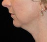 Chin Liposuction