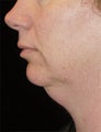 Chin Liposuctioni
