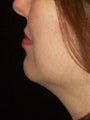Chin Liposuction