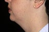 Chin Liposuction