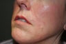 Fillers - Cosmoderm