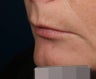 Filler