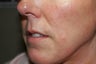Fillers - Cosmoderm