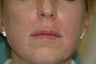 Lip augmentation
