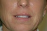 Lip augmentation