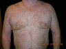 Cool Lipo
