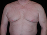 Cool Lipo