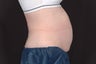 Zeltiq - Non Invasive Fat Reduction in Abdomen - 1 treatment