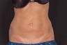 Coolsculpting by Zeltiq to Lower Abs and Love Handles