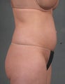 CoolSculpting