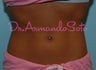 Coolsculpting by Zeltiq