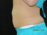 CoolSculpting