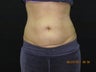 CoolSculpting