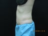 CoolSculpting