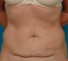 Coolsculpting