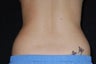 CoolSculpting