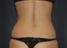 CoolSculpting to the Posterior