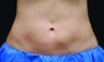 Body contouring