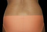 CoolSculpting