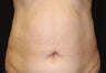 CoolSculpting by zeltiq