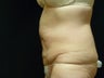 CoolSculpting